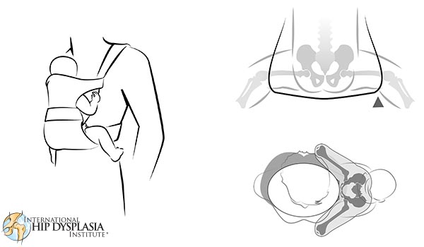hip dysplasia institute baby carriers